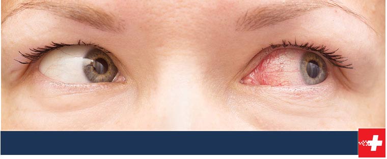 Pink Eye Treatment Near Me in West Moore OK, Norman (HealthPlex) OK, Norman (24th) OK, Edmond OK, Yukon OK, I-240 and Sooner RD OK, Tecumseh OK