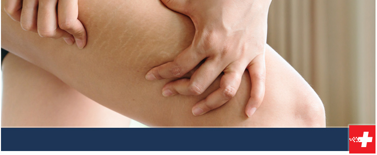 Where Can I Get Cellulitis Treatment in Tecumseh, OK? - Immediate Care of Oklahoma Where Can I Get Cellulitis Treatment in Tecumseh, OK? - Immediate Care of Oklahoma